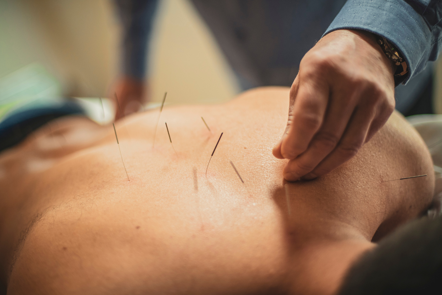 Acupuncture therapy session at Avni Wellness Center, Sector 49 Noida