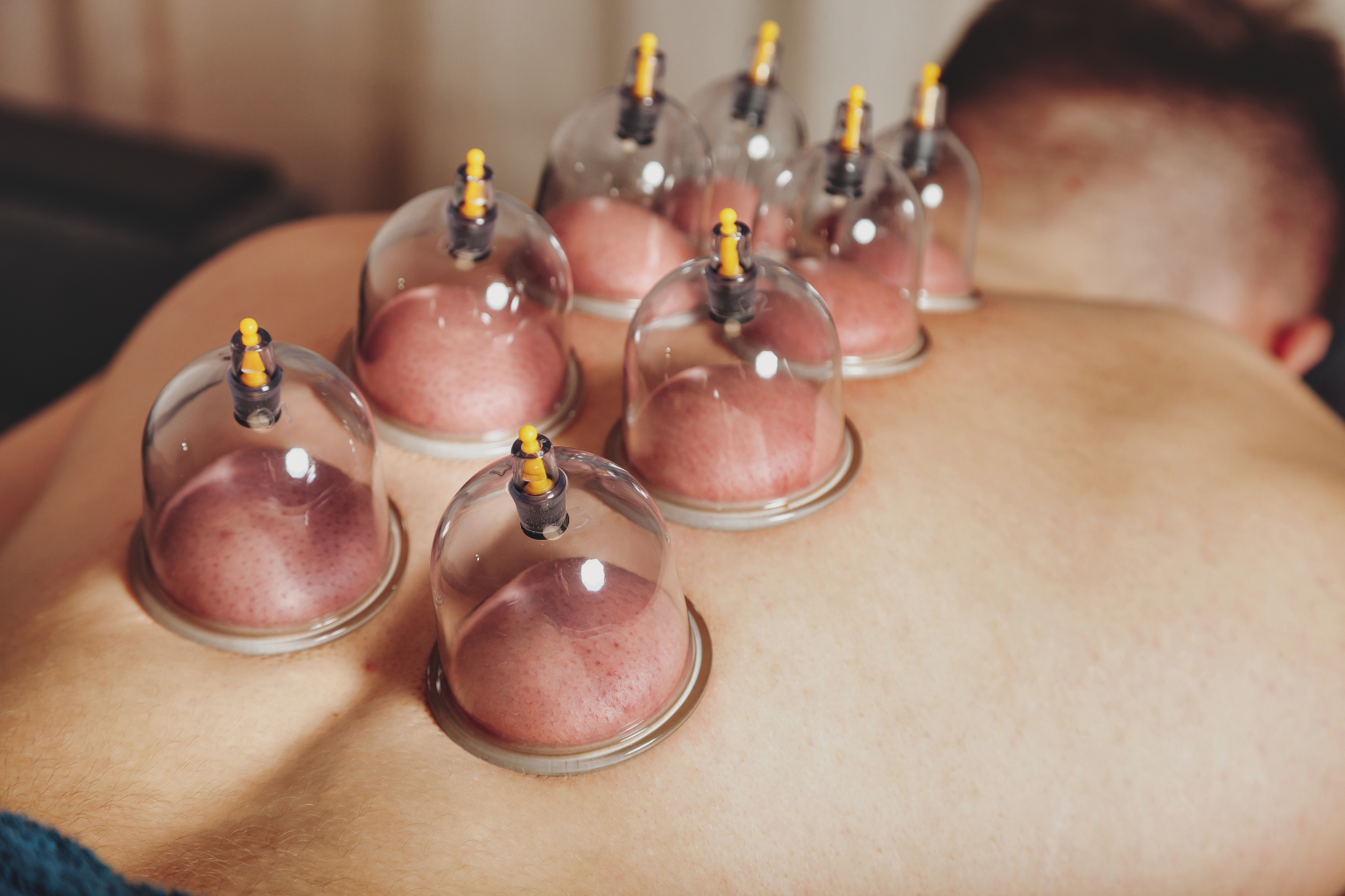 Cupping therapy session at Avni Wellness Center, Sector 49 Noida